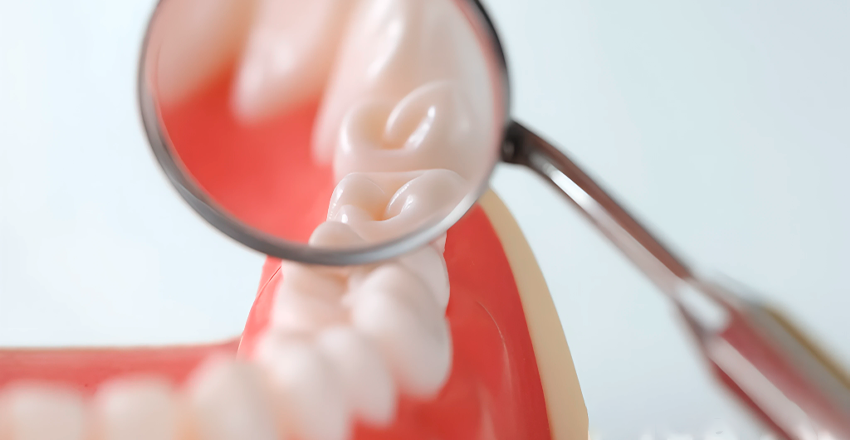 ¿Qué es una caries y cómo se puede prevenir?